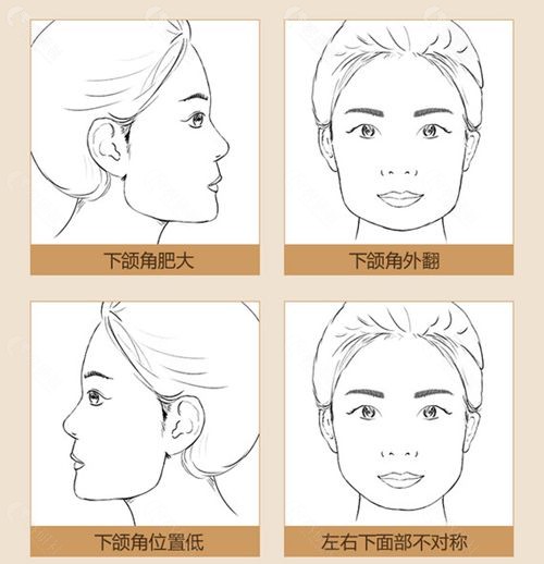 需要做下颌角手术的几种情况