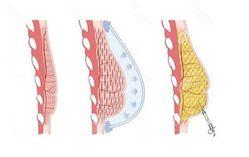 注射丰胸示意图