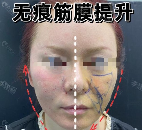 李建钢筋膜提升怎么做的？价格多少？