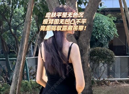 广州军美王娜吸脂真人实例