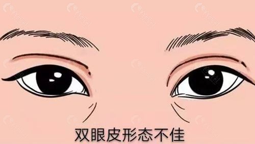 刘庆峰双眼皮修复技术怎么样