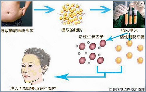 面部脂肪填充的过程