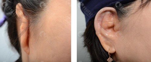 韩国profile普罗菲耳小耳畸形矫正真人实例