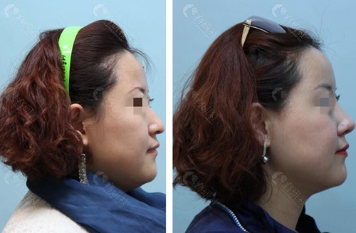 韩国EH眼修复医院隆鼻手术前后对比照