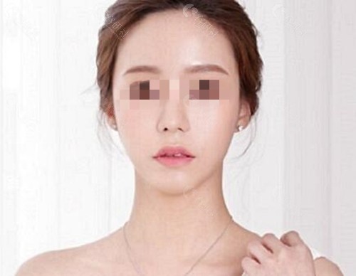 李知赫颧骨手术真人术后图
