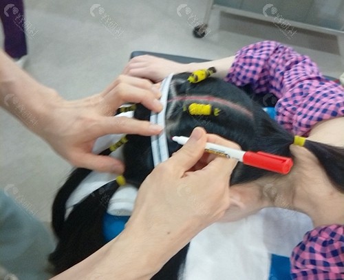 雕刻整形外科骨水泥填充后脑勺有哪些优势