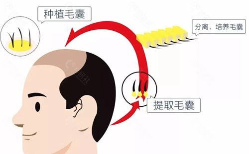 2024广州植发价格贵吗多少钱