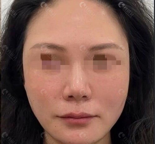 成都李建钢筋膜提升真人实例