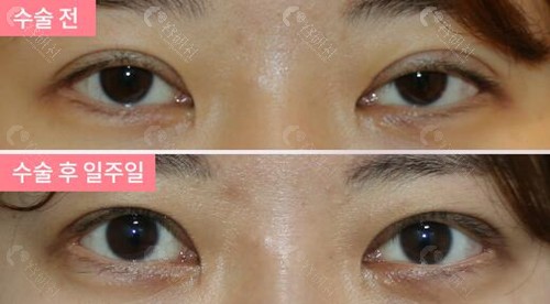 2024韩国双眼皮手术价格表