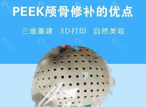 颅骨修复钛网好还是peek材料好