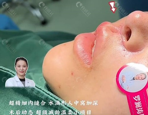 上海罗澜涛医生做人中缩短术优势介绍