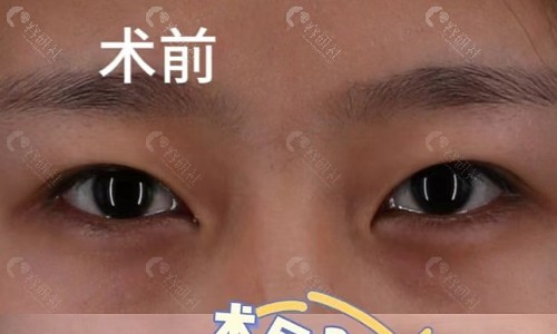 丁庆丰医生的双眼皮手术日记:术前