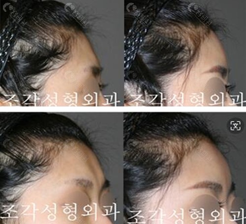韩国雕刻额头整形前后对比图