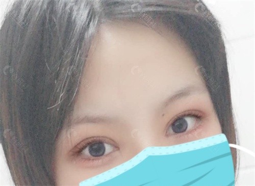 上海郑小红医生修复的眼睛怎么样 上海郑小红医生修复的眼睛怎么样