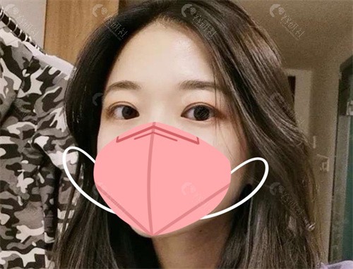 郑小红双眼皮修复好吗 郑小红双眼皮修复好吗