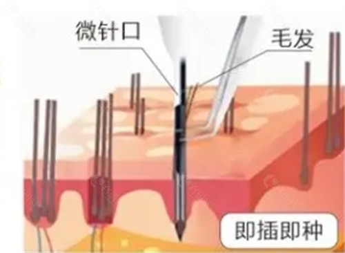 针植发和普通植发的区别