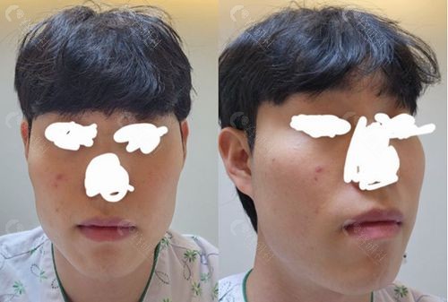 韩国ID医院男士颧骨缩小手术前