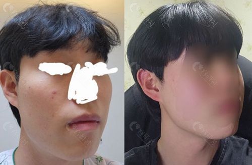 韩国ID医院男士颧骨缩小术前术后对比照