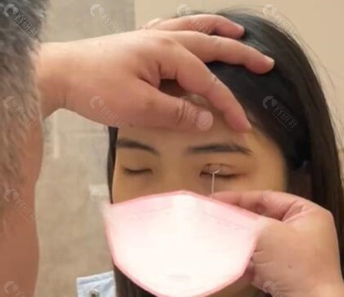 郑州王剑医生修复双眼皮技术优势