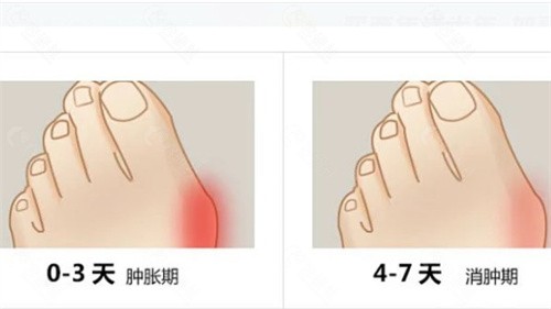 重庆骑士医院做大脚骨拇外翻价格贵不贵