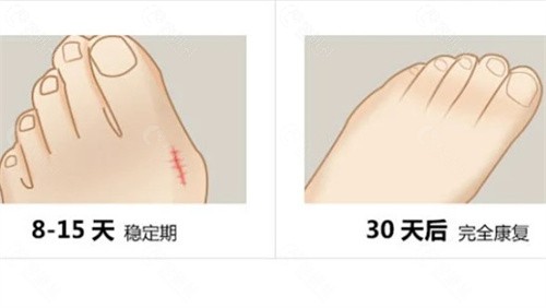 重庆骑士医院大脚骨拇外翻口碑怎么样