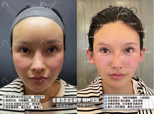杭州浮想国蒋铮铮院长馒化脸修复的手术实例正面照