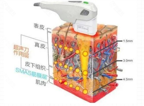 韩国美版超声提升价格是多少？