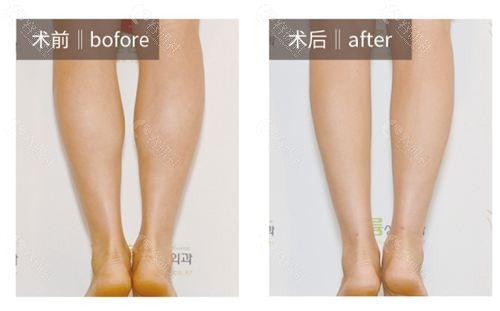 韩国波轮美小腿肌肉阻断术对比图