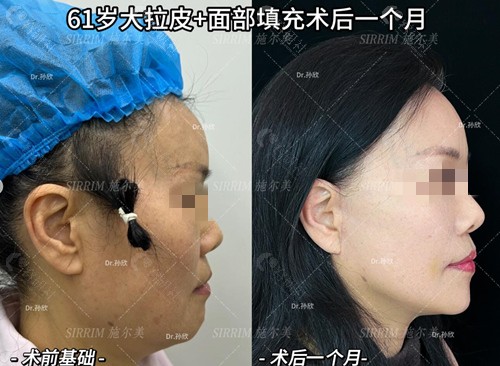 南京施尔美孙欣拉皮前后对比图