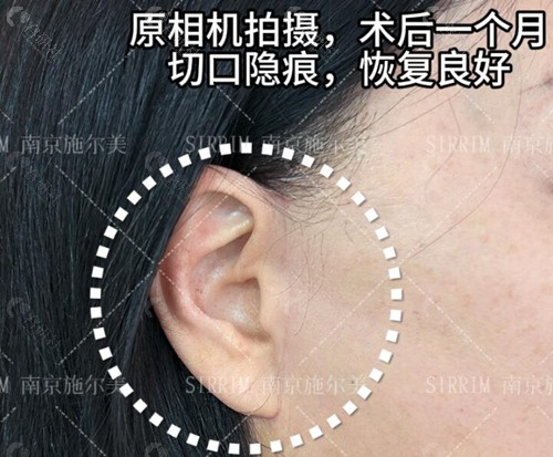南京施尔美孙欣院长拉皮手术优势