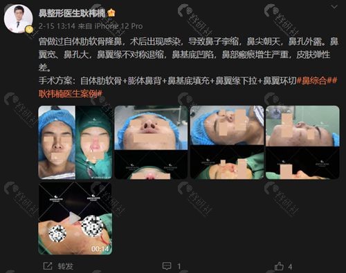 北京鼻整形耿祎楠医生怎么样？耿祎楠做鼻子手术有失败的吗？