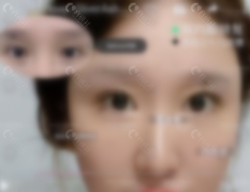 上海刘平修复双眼皮怎么样？