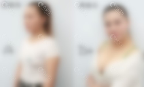 上海美莱汪灏隆胸真人实例