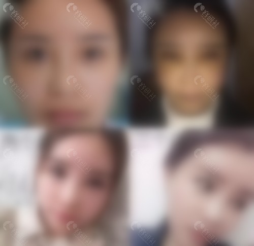 张海明医生高难度眼修复真人实例