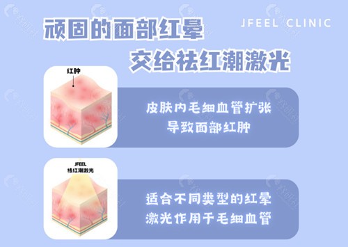 韩国jfeel皮肤科医院祛红潮激光怎么样