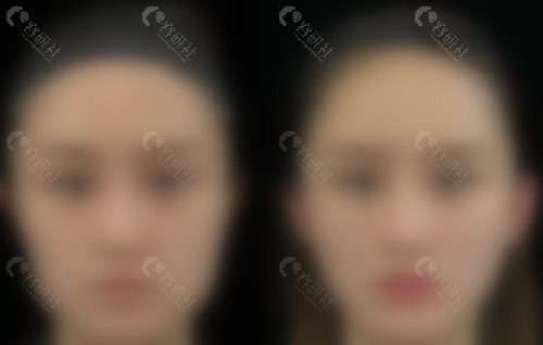 武汉朱胜军打玻尿酸怎么样？