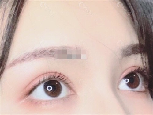 武伟亮双眼皮实例