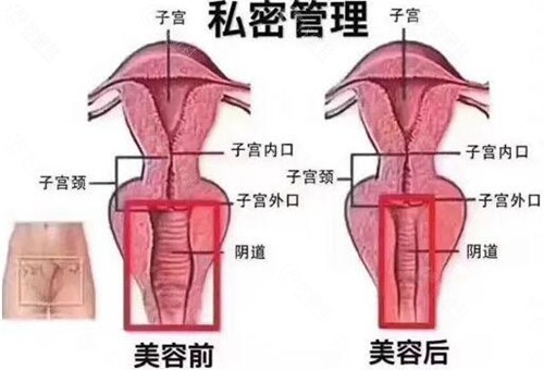 郑芳园做私密紧缩手术优势介绍