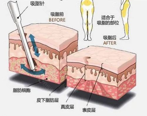 韩国Slim Young皮肤科吸脂怎么样