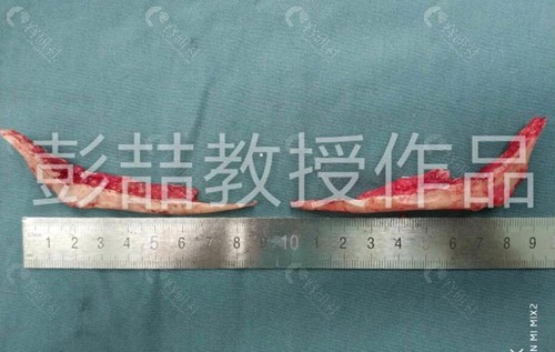 彭喆下颌角和颧骨手术优势介绍