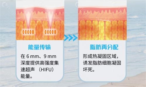 ULFIT优飞塑做脸/身体多少钱一次