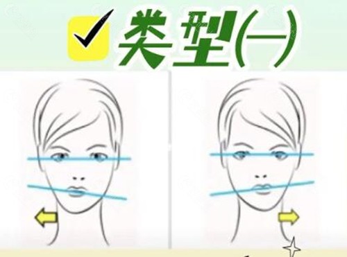 下巴歪导致脸歪怎么办？