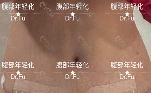 傅秀军腹壁整形真人实例