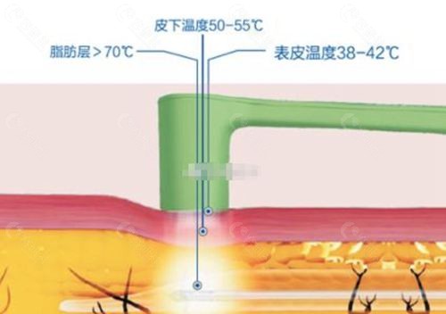 5g天使光雕吸脂优势解析