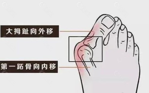 温氏拇外翻手术怎么样？