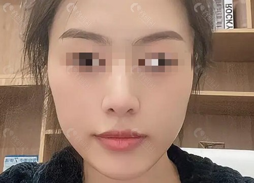 房志强医生隆鼻真人实例