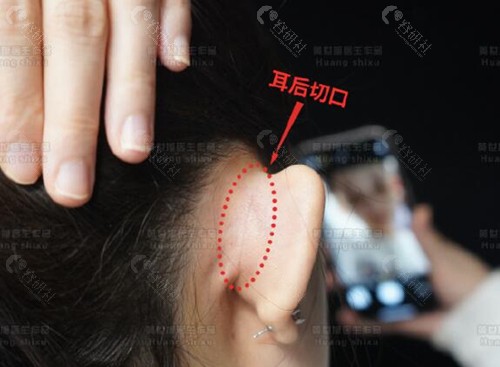 黄世旭精灵耳矫正手术预约挂号