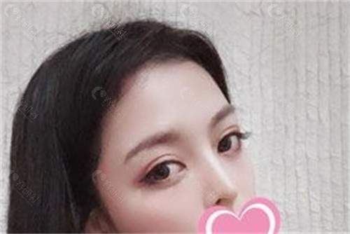北京张海明做的双眼皮怎么样