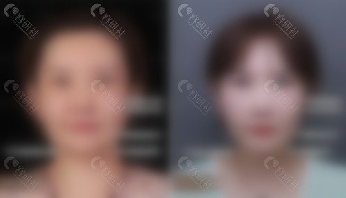 北京艺美医疗王东脂肪填充优势介绍