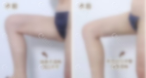 北京艺美医疗王东脂肪填充修复真人实例